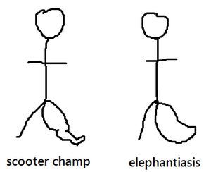 scooter-elephantiasis.jpg
